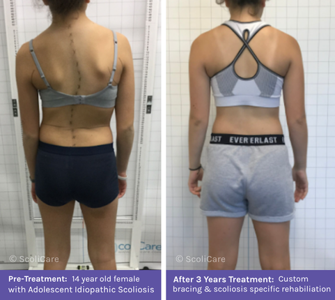 AIS (1) Adolescent Idiopathic Scoliosis