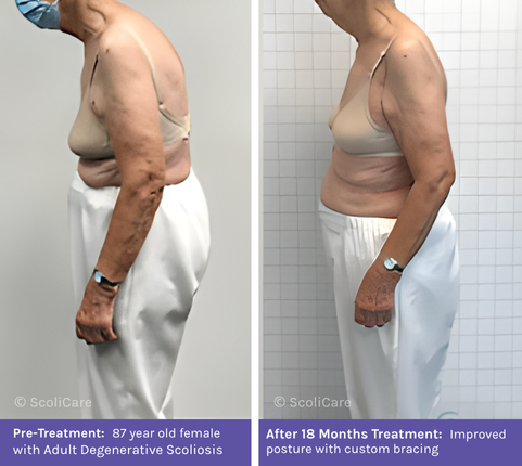 Adult (1) Adult Scoliosis