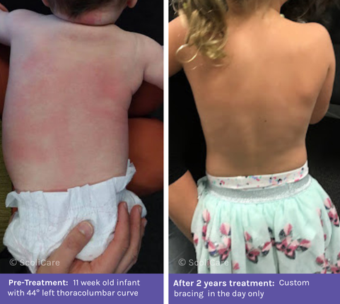 Infantile (1) Infantile Scoliosis