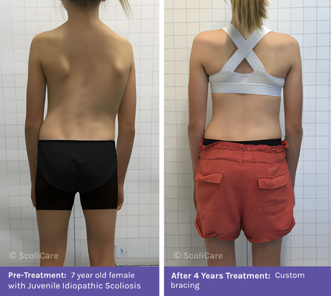 Juvenile (1) Juvenil Scoliosis